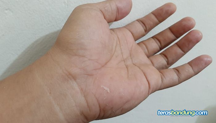 4 Tip Mengatasi Kulit Kering, Bisa Dilakukan Sendiri di Rumah