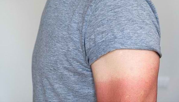 7 Cara Mengatasi Kulit Belang Mudah dan Alami Bisa Dilakukan Sendiri di Rumah