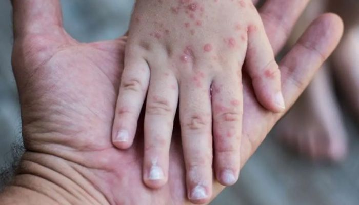 Waspada Campak! Dinkes Bandung Minta Warga Kenali Gejala Sejak Dini